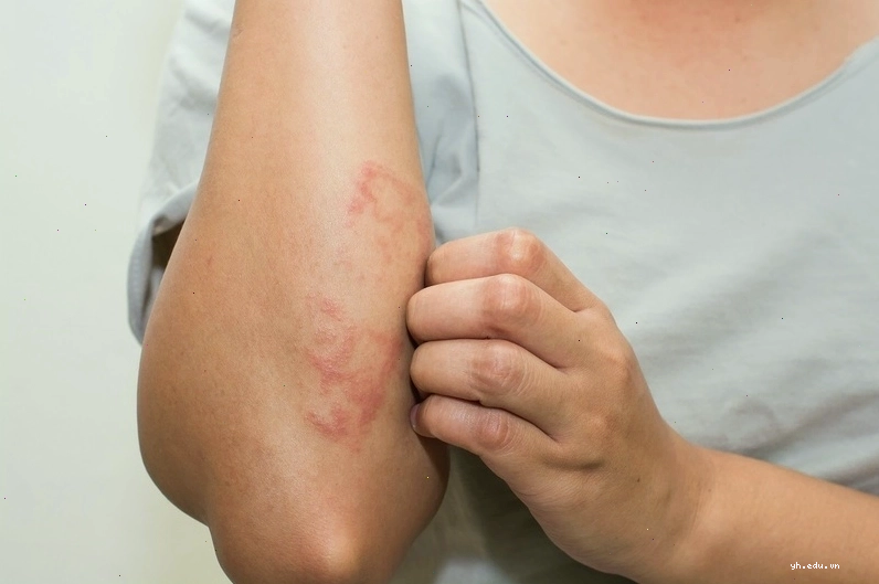 Cách phòng ngừa tụ cầu khuẩn