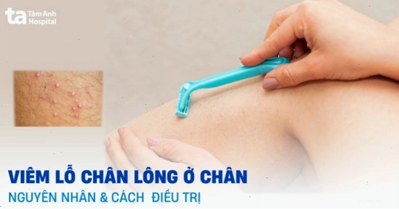 Cách trị viêm lỗ chân lông ở chân tại nhà và nguyên nhân cụ thể
