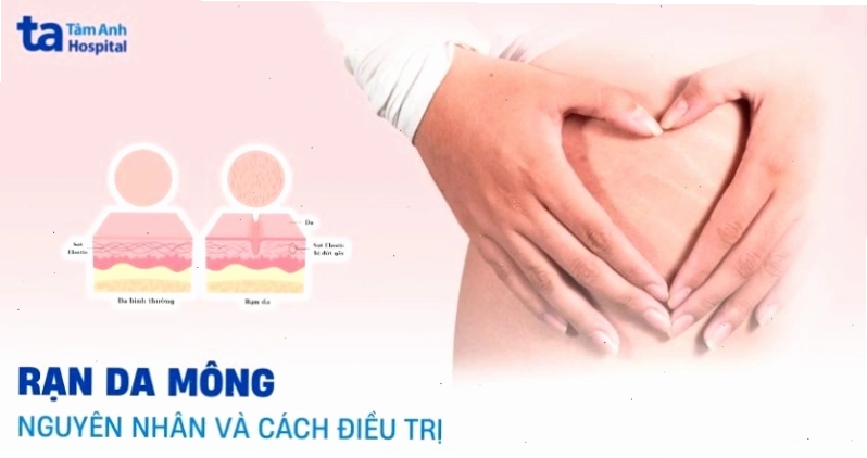 Cách xử lý rạn da vùng mông tại nhà