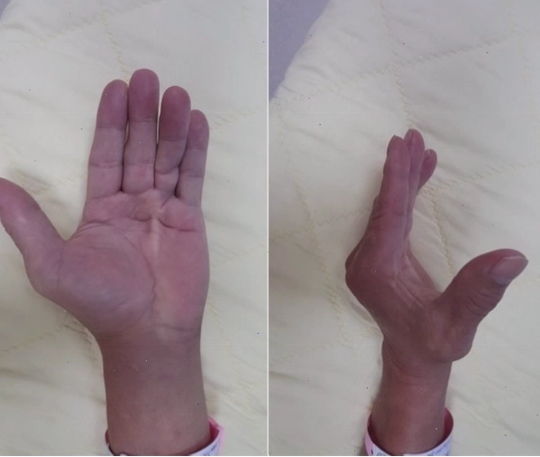 Cần làm gì khi đau co rút bàn tay