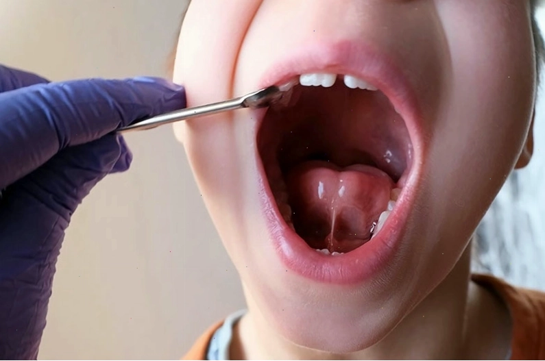 Cắt thắng lưỡi ở trẻ là phương pháp điều trị thường được chỉ định
