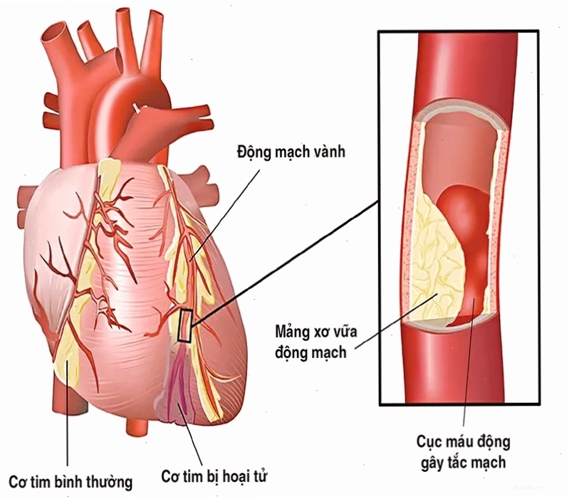 Cấu trúc động mạch bị tắc nghẽn do mảng xơ vữa tích tụ
