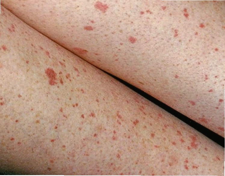 Cấu trúc mạch máu dưới da bị tổn thương