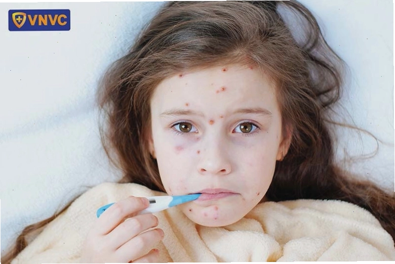 Cha mẹ đo nhiệt độ cho bé bị mắc bệnh thủy đậu