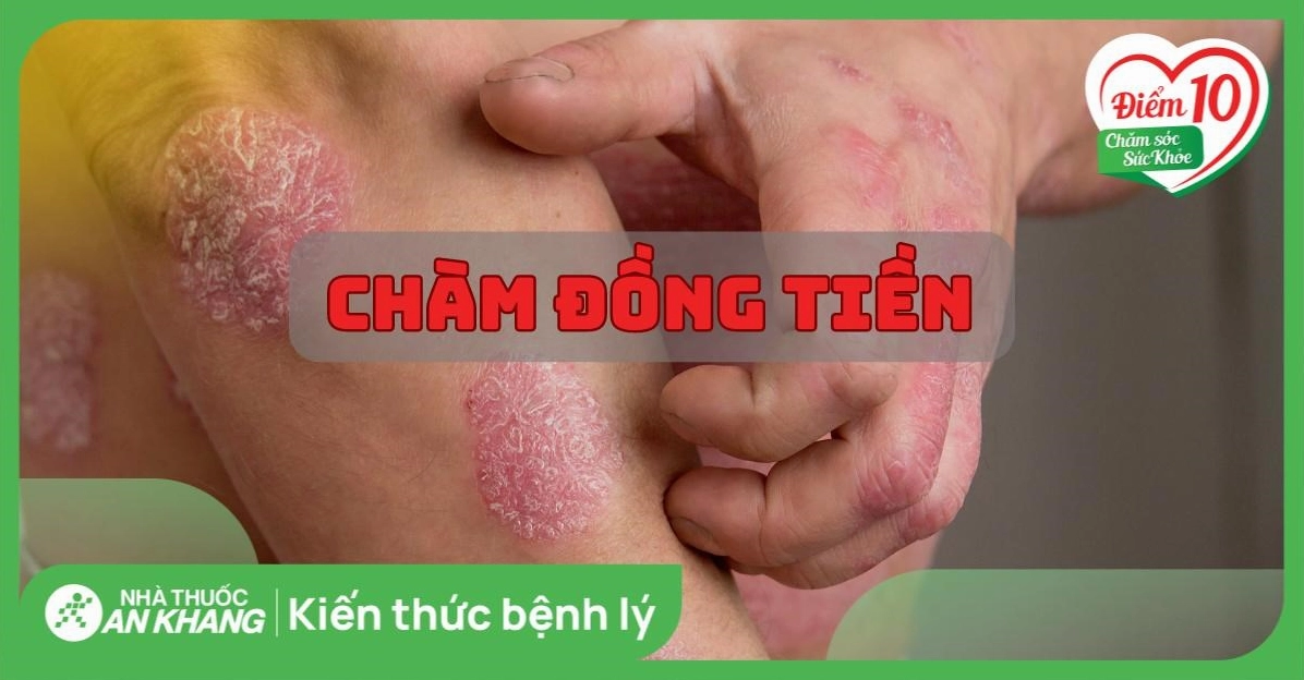 Chàm đồng tiền là bệnh gì và các dấu hiệu nhận biết cần lưu ý