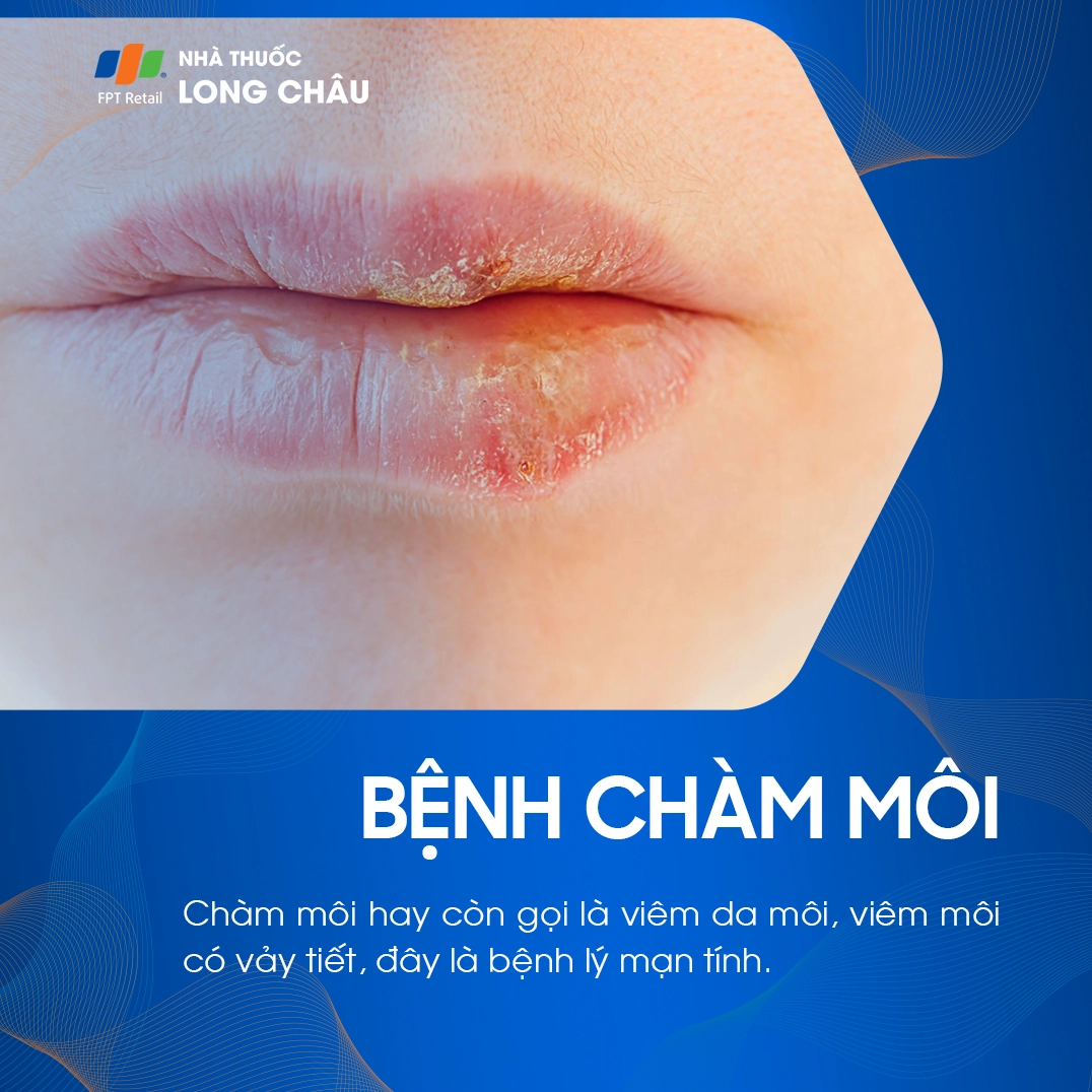 Chàm môi là bệnh gì và những lưu ý quan trọng để điều trị hiệu quả