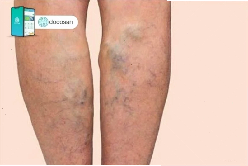Chân bị phù nặng do giãn tĩnh mạch