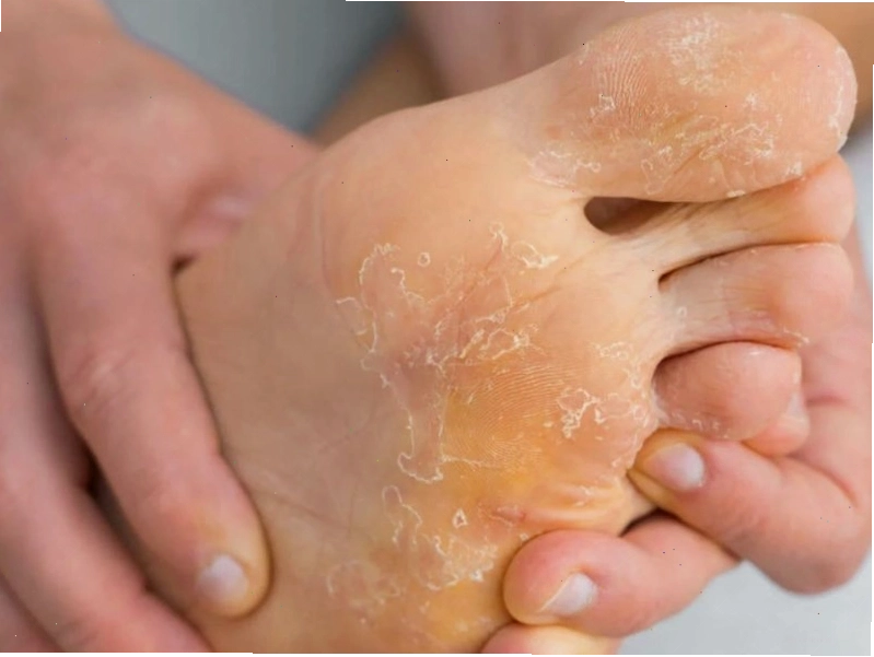 Chân bị tróc da do thiếu hụt vi chất dinh dưỡng