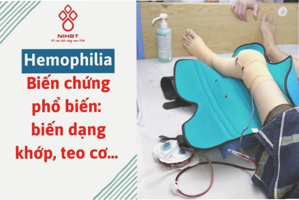 Chảy máu trong cơ khớp