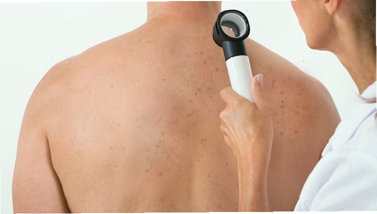 Chế độ ăn uống giúp trị mụn
