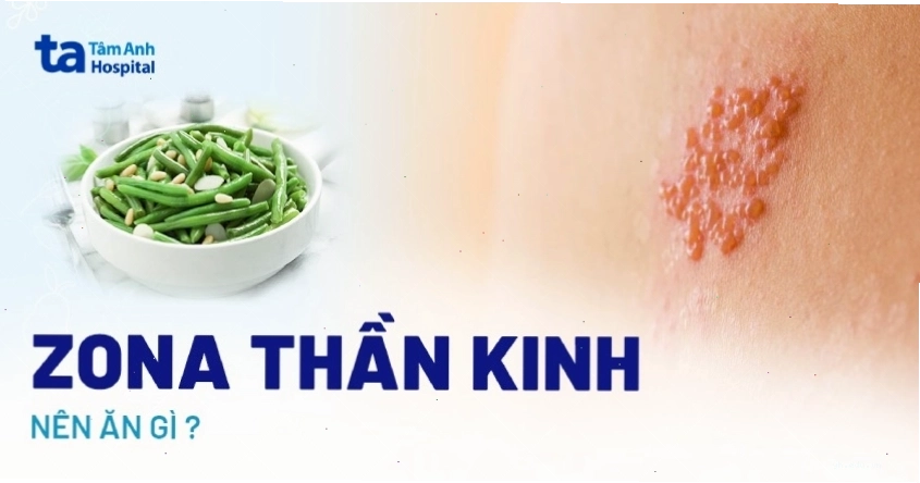 Chế độ ăn uống khi bị Zona thần kinh