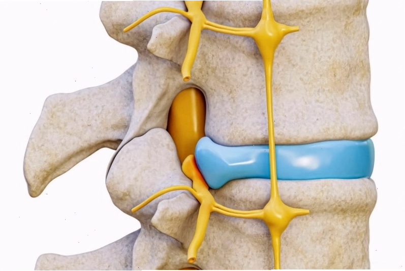 Chèn ép dây thần kinh dẫn đến dị cảm