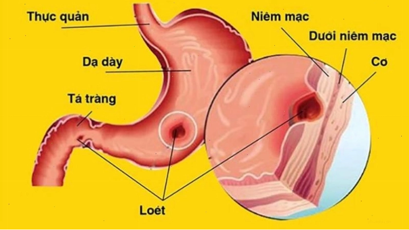 Chiết xuất từ lá cây khế chứa terpenoid, flavonoid và chất nhầy có hoạt tính chống loét