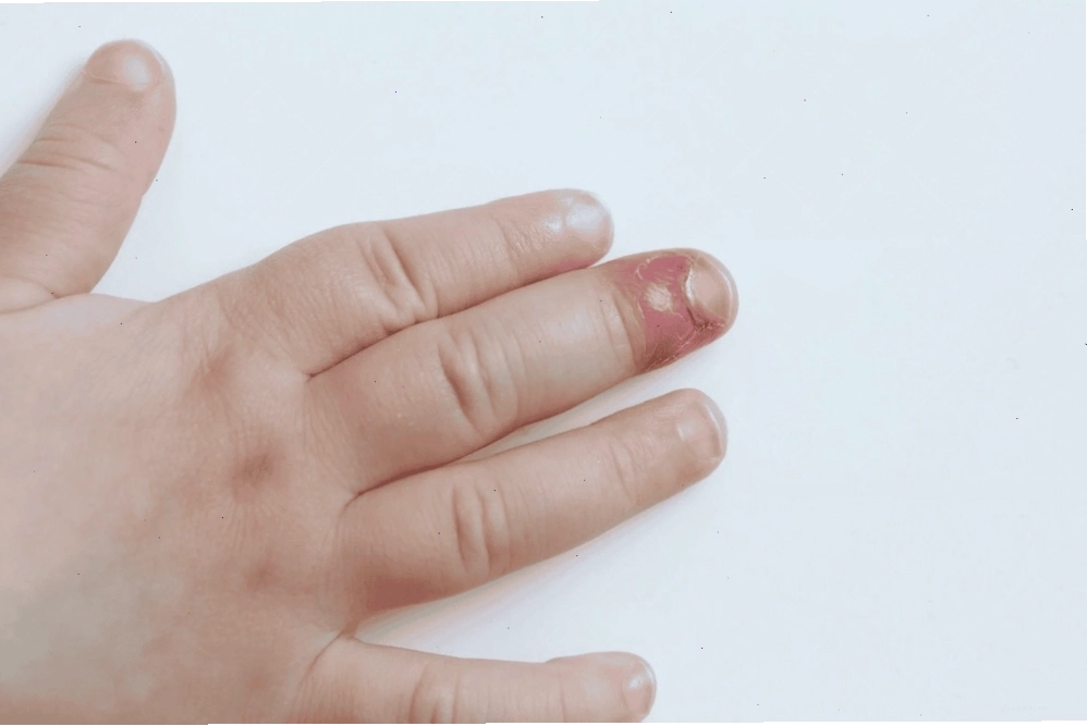 Chín mé bị sưng viêm mủ có thể dẫn tới viêm xương