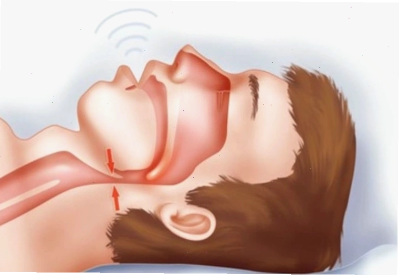 Chứng ngưng thở khi ngủ gây chảy nước bọt