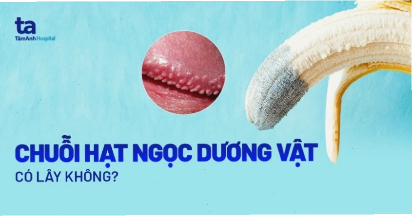 Chuỗi hạt ngọc dương vật có lây không