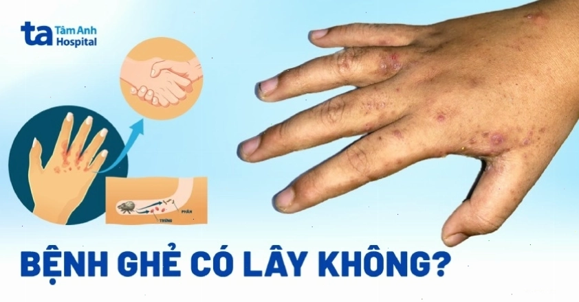 Cơ chế lây truyền của bệnh ghẻ
