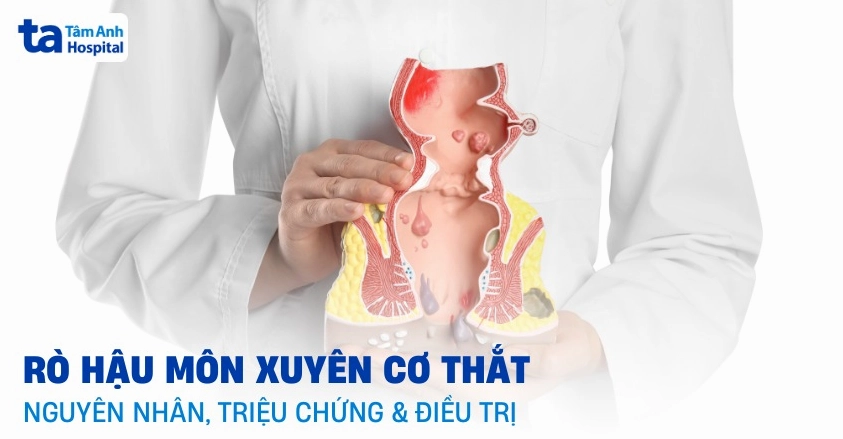 Co thắt hậu môn la bệnh gì và dấu hiệu nhận biết tình trạng này