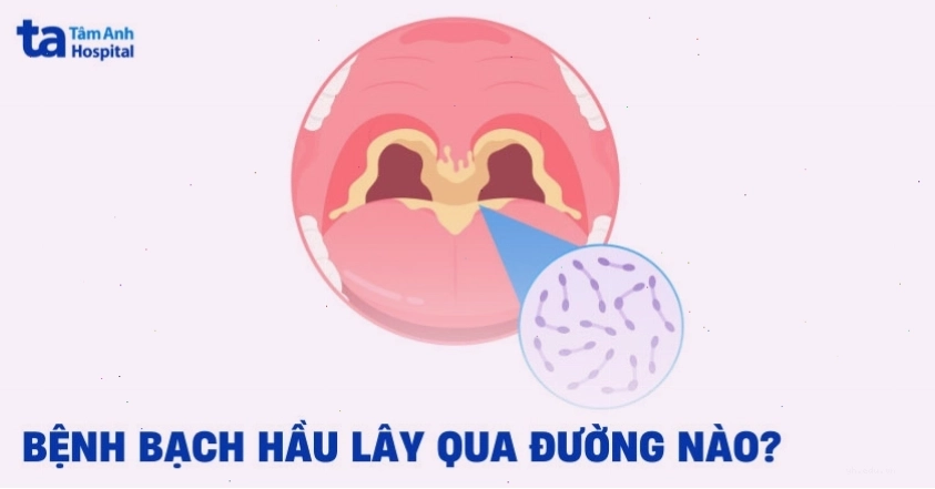 Con đường lây lan bệnh bạch hầu trong cộng đồng