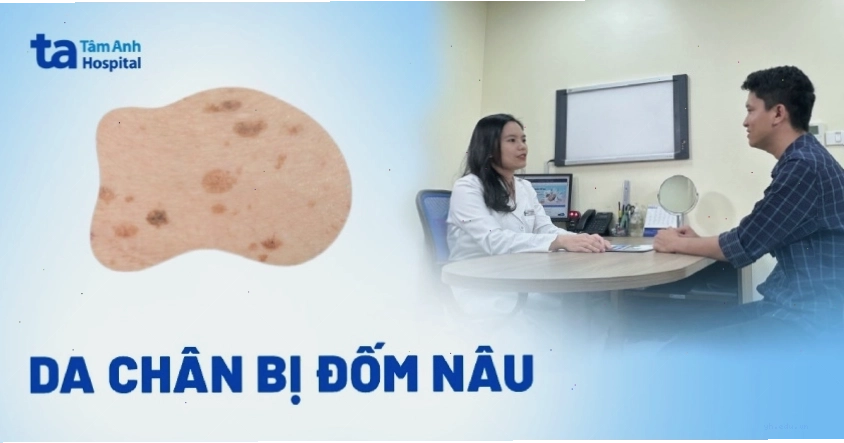 Da chân bị đốm nâu: Nguyên nhân, dấu hiệu và cách điều trị
