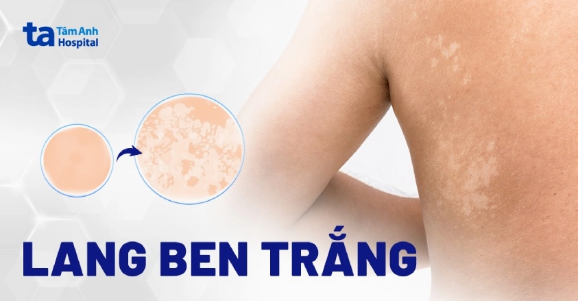Da loang lổ là bệnh gì và những điều cần biết để xử lý hiệu quả