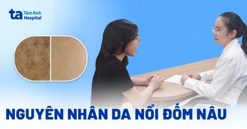 da nổi đốm nâu