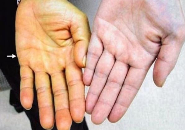 Da tay bị vàng là bệnh gì và những nguyên nhân tiềm ẩn cần lưu ý