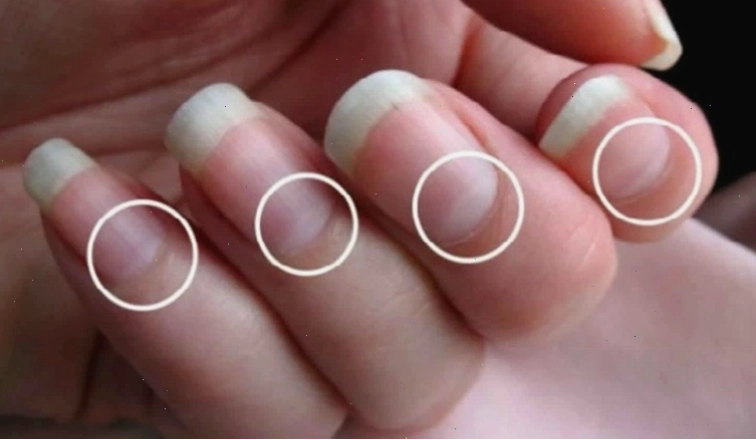 Dấu hiệu bất thường trên màu sắc móng tay cần được theo dõi