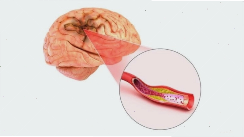Dấu hiệu cảnh báo đột quỵ thông qua triệu chứng tê mặt
