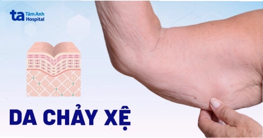 Dấu hiệu da chảy xệ rõ rệt