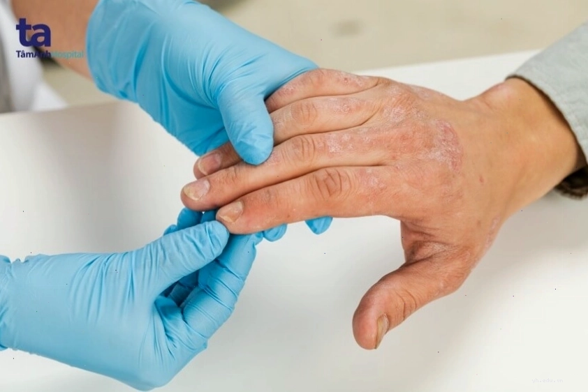 Dấu hiệu nhận biết các triệu chứng bệnh chàm sớm