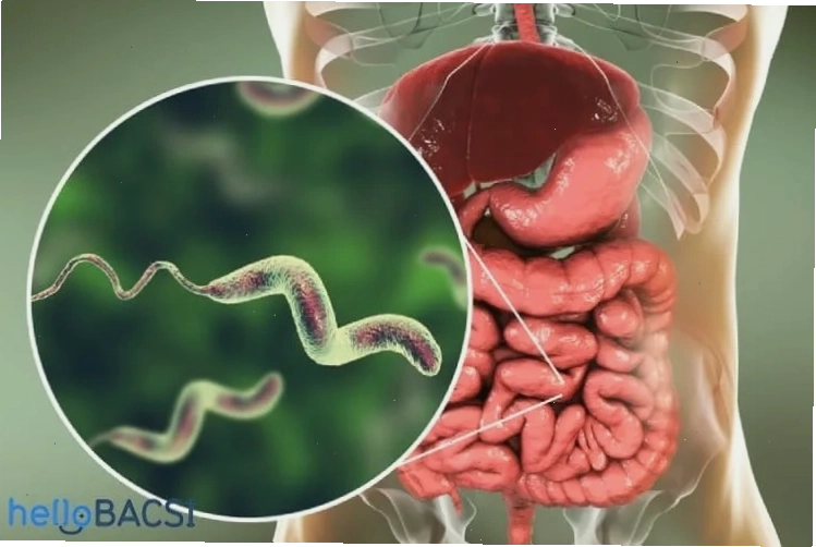 Dấu hiệu nhận biết nhiễm vi khuẩn Campylobacter jejuni