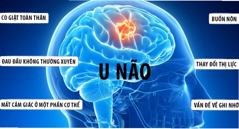 Dấu hiệu nhận biết sớm bệnh u não