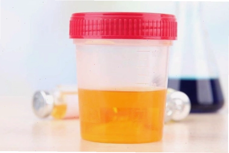 Dấu hiệu nước tiểu vàng sậm ở người bệnh tuyến tiền liệt