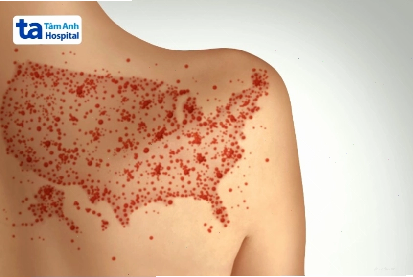 Dấu hiệu phát ban trên da người bệnh