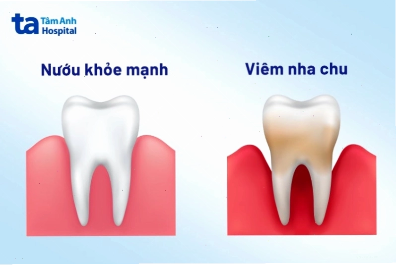 Dấu hiệu sưng đỏ nướu do viêm nha chu
