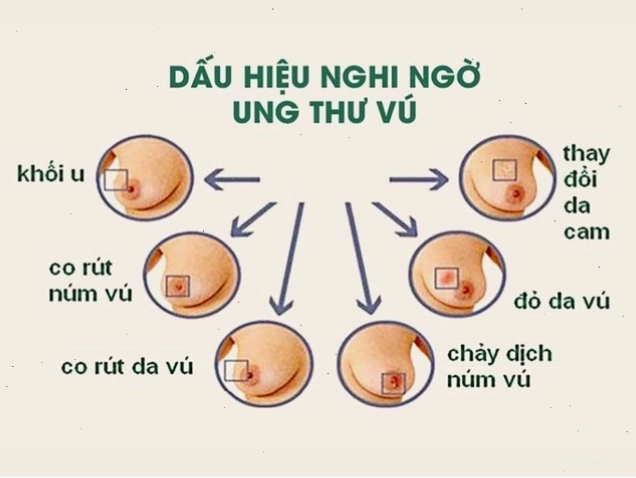 Dấu hiệu ung thư vú