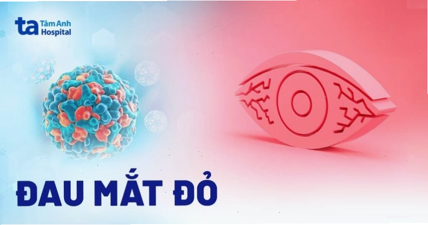 đau mắt đỏ