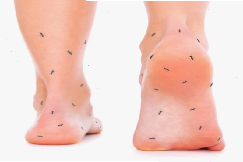 Dị cảm là một cảm giác bất thường trên da, thường được mô tả như tê bì, kiến bò