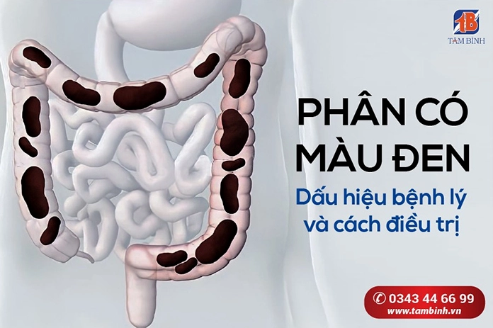 Đi cầu phân đen có bệnh gì không và những cảnh báo y khoa cần biết
