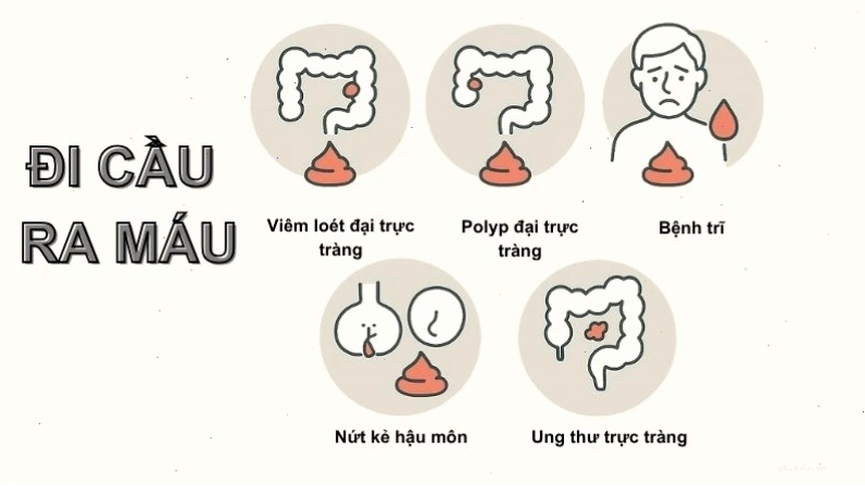 Đi cầu ra máu là dấu hiệu của nhiều bệnh lý nguy hiểm