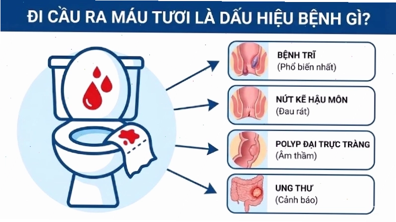 Đi cầu ra máu tươi là dấu hiệu của bệnh gì