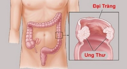 Đi đại tiện nhiều lần trong ngày là bệnh gì và cách xử lý hiệu quả