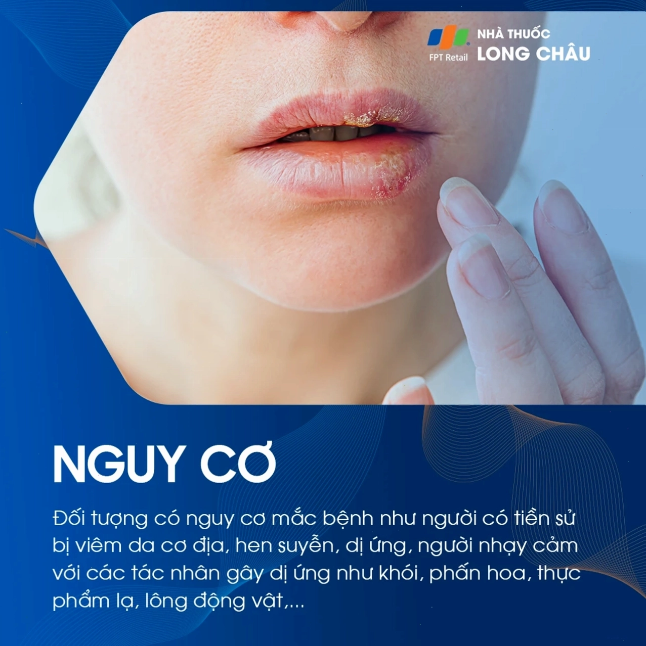 Đối tượng dễ mắc bệnh chàm môi