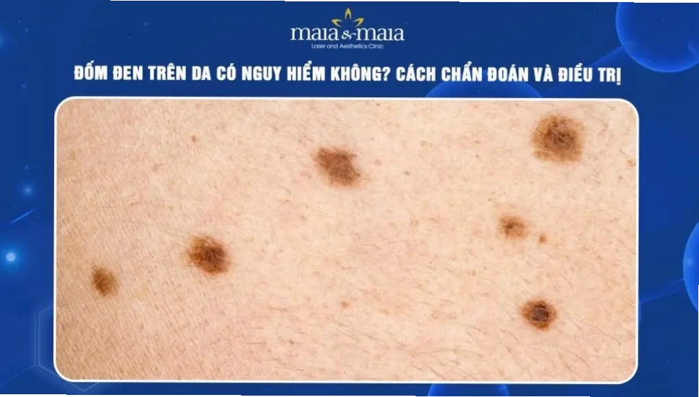 Đốm đen trên da