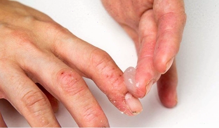 Dùng kem dưỡng ẩm cải thiện tình trạng tróc da