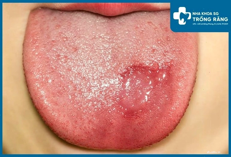 Gai lưỡi bị tổn thương thành một mảng to
