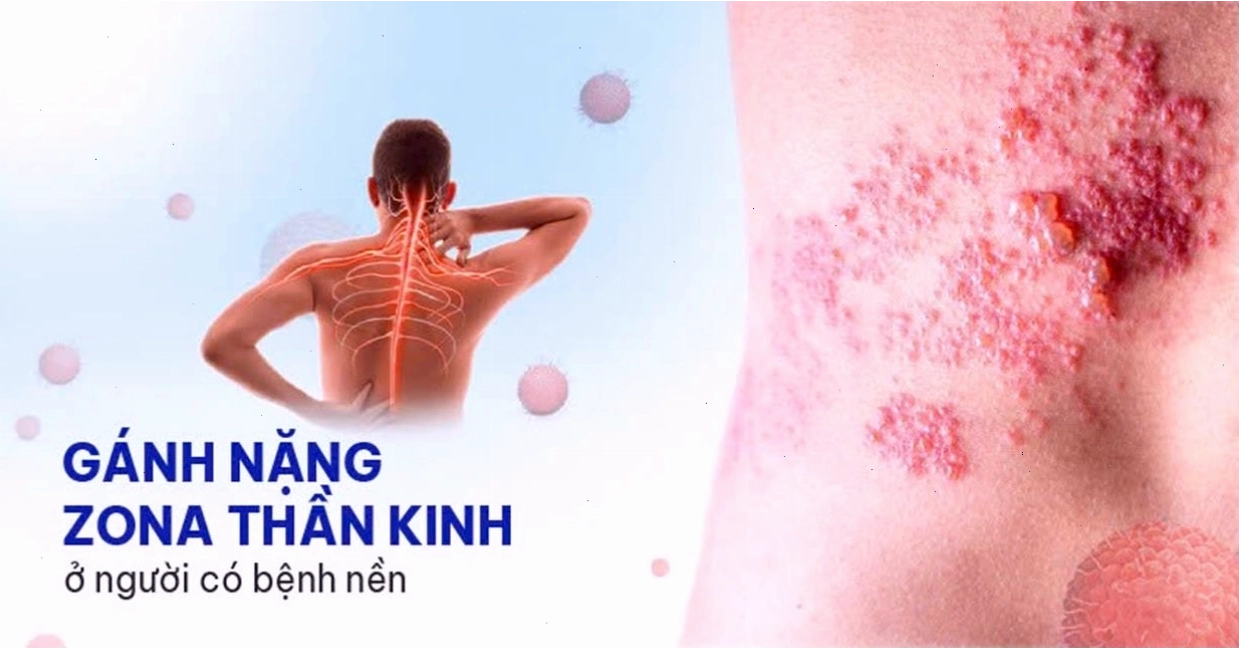 Gánh nặng bệnh nền