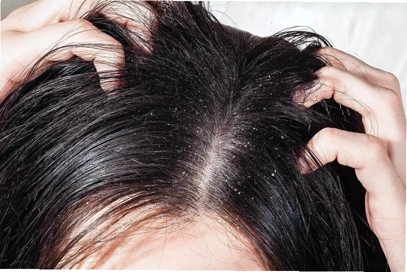 Gàu là dấu hiệu sớm của bệnh