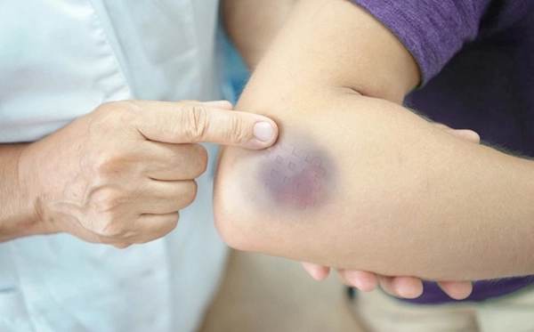 Giải đáp bầm tím không rõ nguyên nhân là bệnh gì và dấu hiệu nguy hiểm